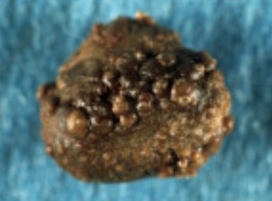 Nodular stone